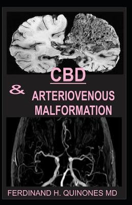 CBD & Arteriovenous Malformation: All You Need To Know About Using CBD Oil for Treating ARTERIOVENOUS MALFORMATION by H. Quinones MD, Ferdinand