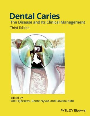 Dental Caries, Third Edition by Fejerskov, Ole