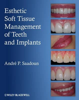 Esthetic Soft Tissue Management of Teeth and Implants by Saadoun, Andre P.